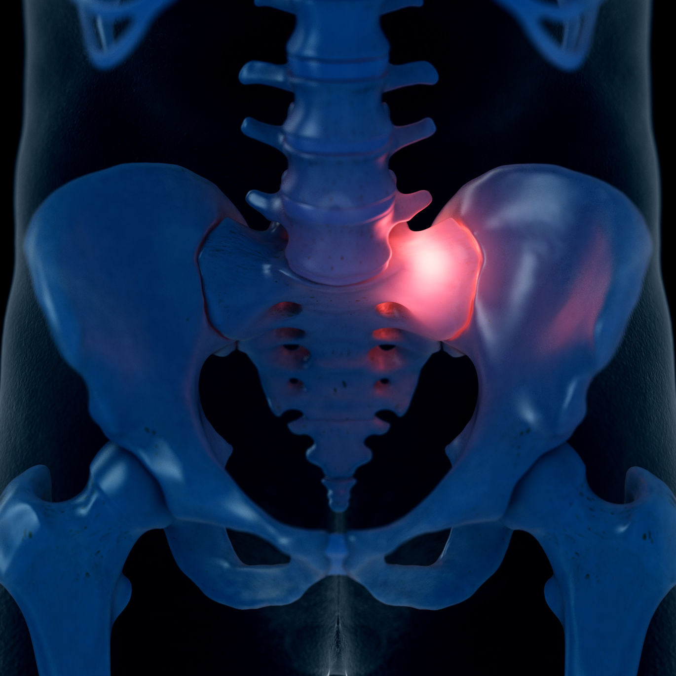 tens unit electrode placement for si joint pain