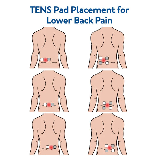 Transcutaneous Electrical Nerve Stimulation (TENS)